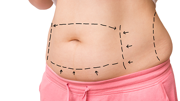 Are Tummy Tucks Painful? | Siwy Plastic Surgery
