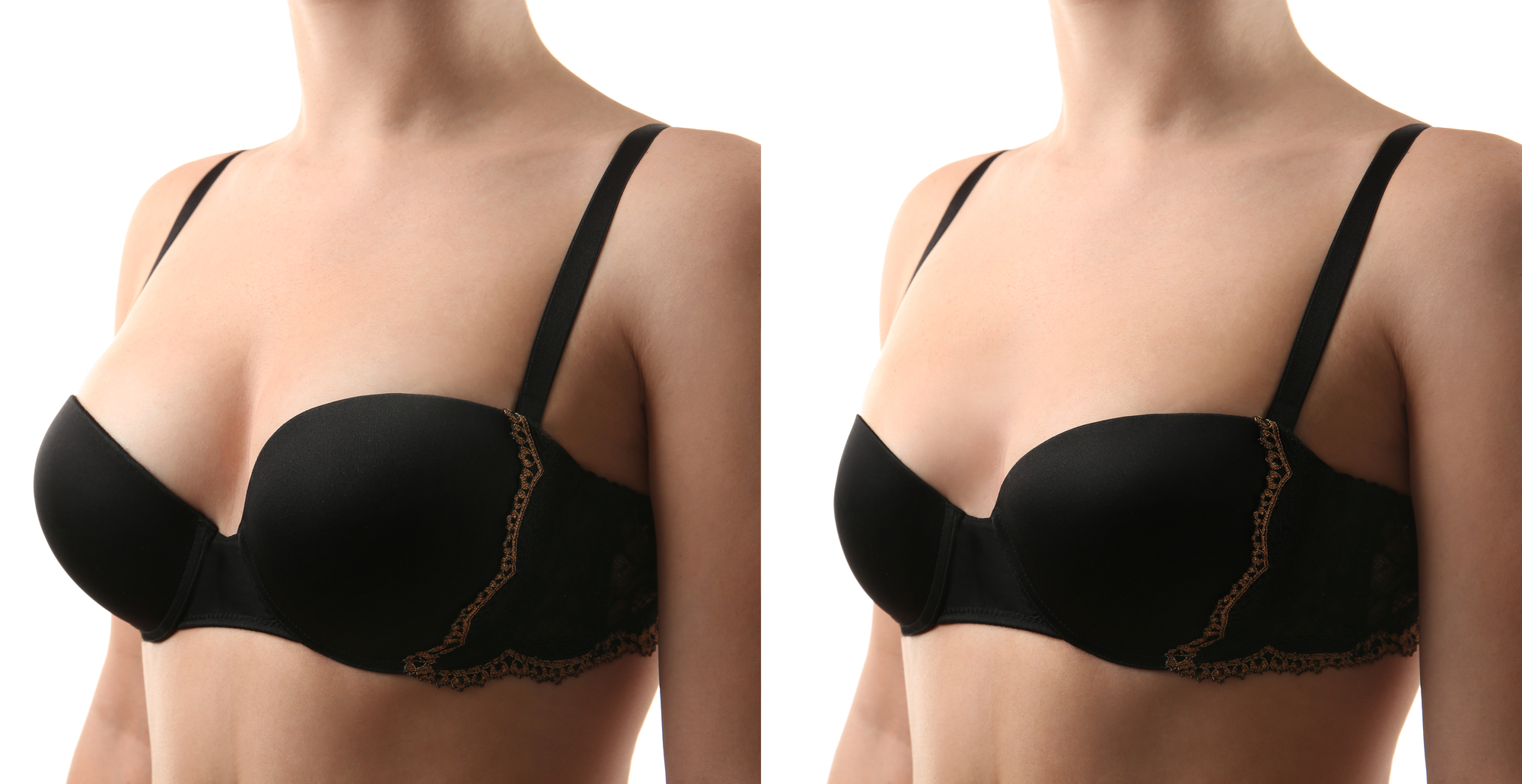 Breast Reduction Surgery  Breast Reduction Surgery Before & After